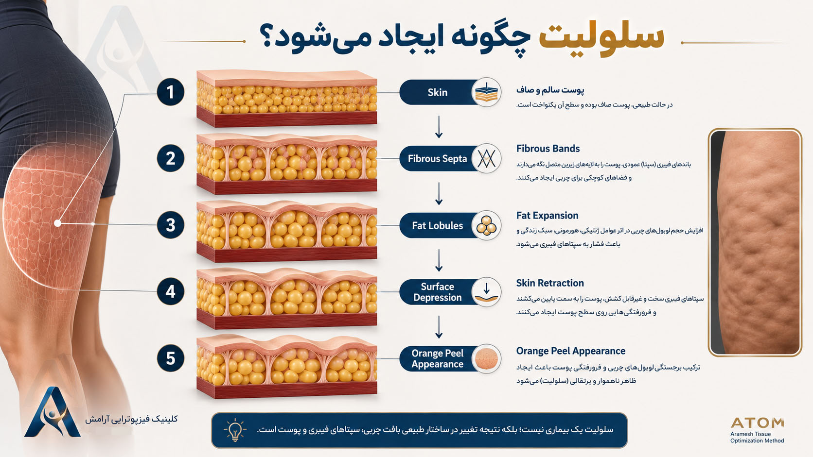 سلولیت چگونه ایجاد میشود